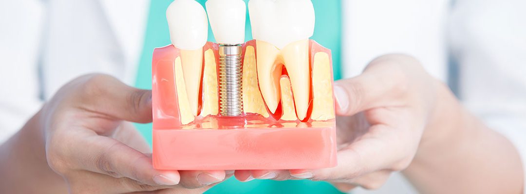 TYPES OF DENTAL IMPLANTS