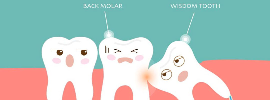 UNDERSTANDING WISDOM TEETH