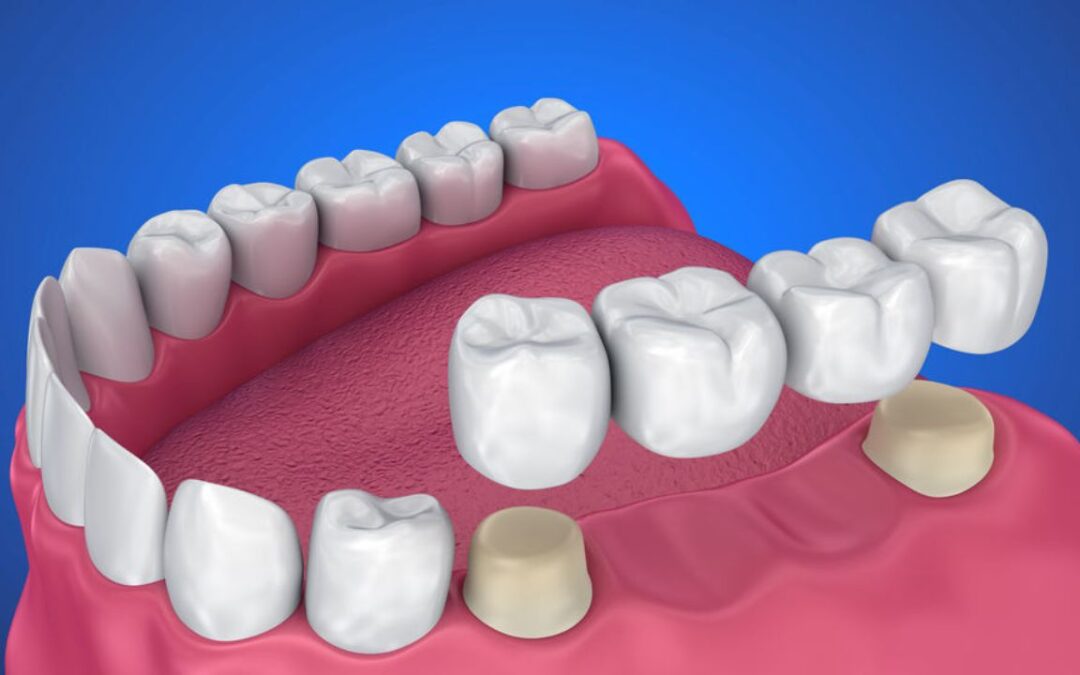 Can a Dental Bridge Be Removed and Recemented?