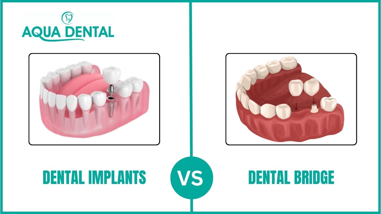 Dental Bridge vs Dental Implant | Guide and Cost Details