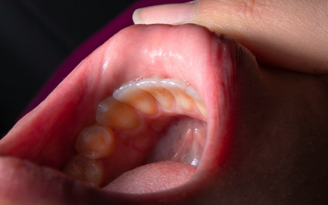 Periodontal Disease Stages Explained: From Gingivitis to Advanced Periodontitis